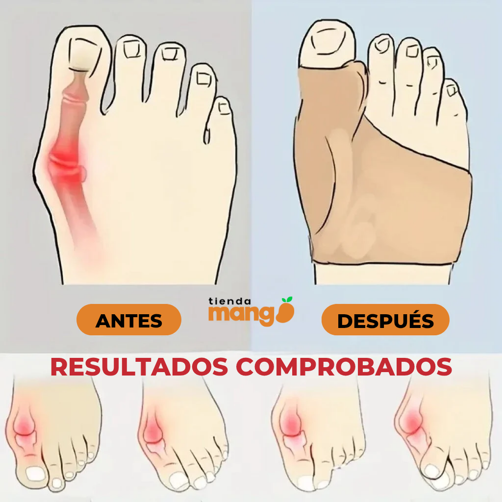 CorrectionMax - Corrector Ortipedico de Juanetes Premium (Ultimas Unidades)